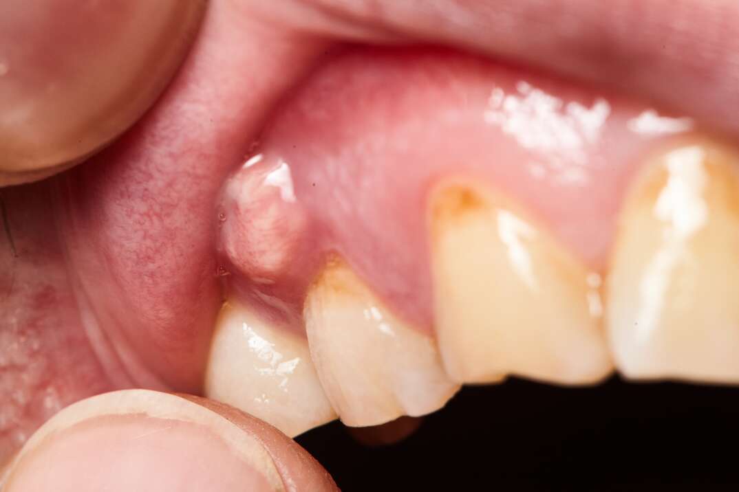 A closeup photo of a dental abscess shows human fingers holding the persons lips apart in order to get a look at the large protrusion that has formed on the gums of their plaque stained upper teeth, plaque, upper teeth, teeth, closeup, abscess, dental abscess, dental, dentist, medical, fingers, mouth, lips, gums, healthcare, health care, medical care, dental care, dental health