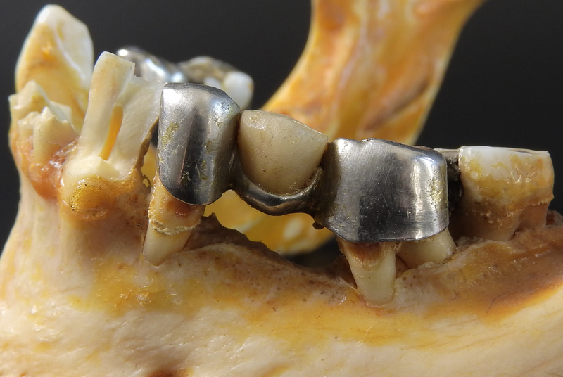 A closeup of the lower jaw of a skeletal cranium has a gray metal dental bridge across a row of three teeth, teeth, tooth, human teeth, human tooth, jaw, mouth, mandible, skeleton, skull, cranium, lower jaw, dental, dental bridge, bridge