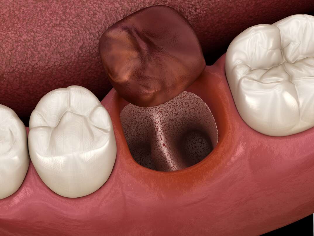 A medically accurate 3D illustration shows the dry socket condition after a tooth extraction as the brown colored extracted tooth sits to the side of the crater left behind among three other healthy white teeth and pink gums, teeth, white teeth, gums, pink gums, extracted tooth, crater, brown tooth, mouth, inside mouth, 3D illustration, illustration, 3D, dental, dental procedure, medical, medical procedure, dentist, tooth extraction, tooth, extraction, pulled tooth