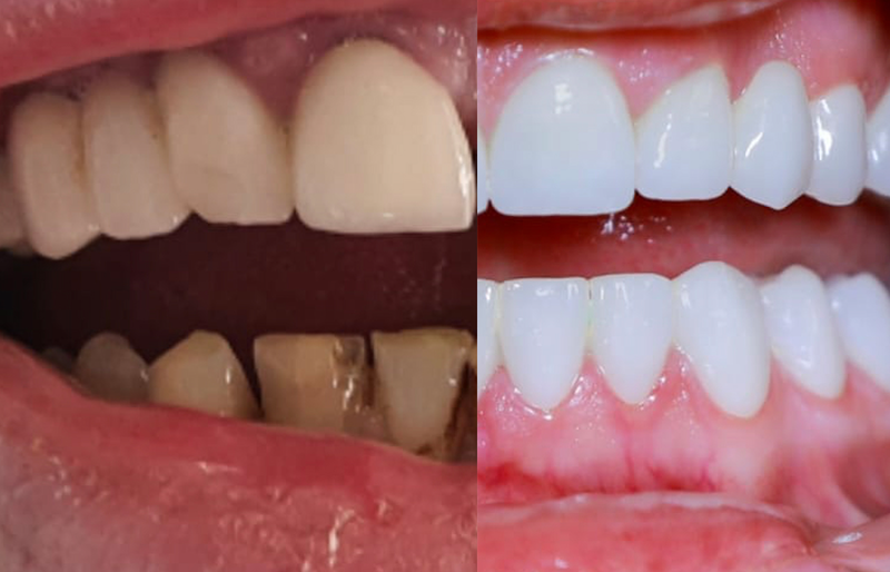 A composite photo shows a closeup of a mouth with dark colored neglected teeth on the left side and pristine pearly white teeth on the right side, teeth, tooth, mouth, closeup, teeth whitening, tooth whitening, teeth, tooth, whitening, dentist, dentistry, dental, lips