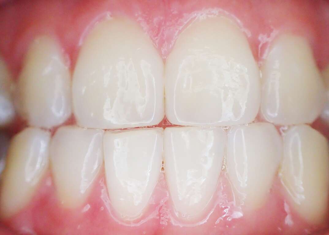 An extreme closeup inside a human mouth shows clenched white teeth and pink gums, gums, teeth, tooth, clenched teeth, white teeth, clenched jaw, inside mouth, human mouth, human, mouth, canines, bicuspids, dentist, dentistry, dental, dental implants