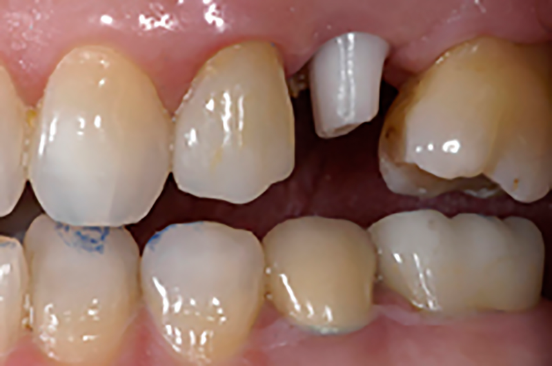 A closeup of a dental crown procedure is shown, dental, dental procedure, dental surgery, surgery, tooth, teeth, crown, dental crown, human teeth, dental implant, oral, oral surgery