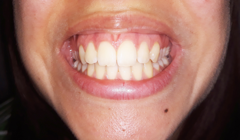 The lower half of a human face is shown in closeup with a large toothy smile, teeth, tooth, smile, mouth, face, chin, lips