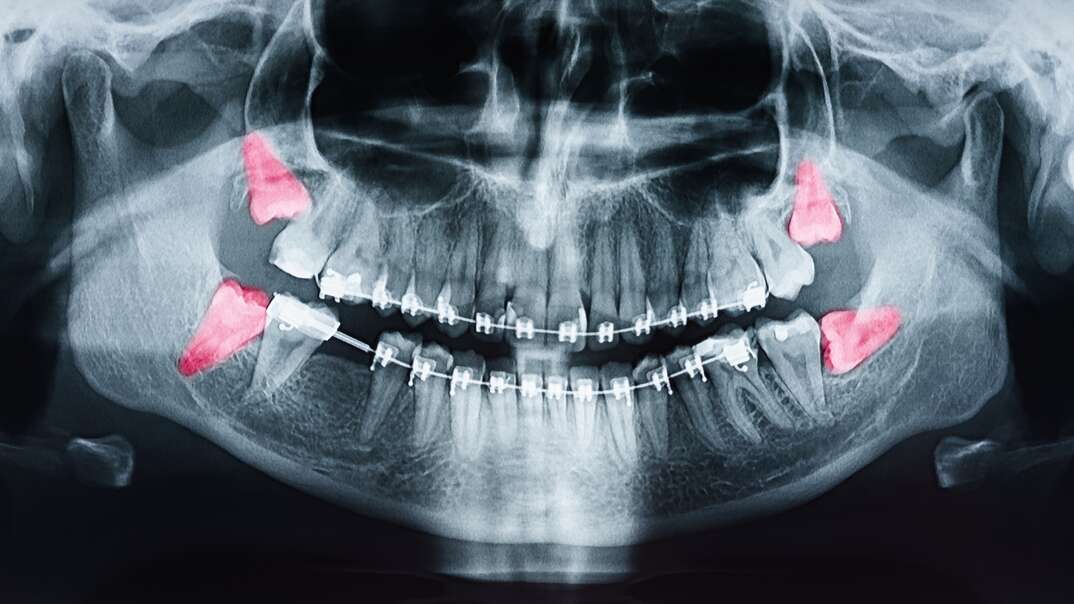 An X ray image of a human mouth shows wisdom teeth highlighted in red against the black and white backdrop to indicate inflammation and the need to be removed, wisdom teeth, teeth, tooth, jaw, mouth, human mouth, inflammation, pain, red, medical, oral