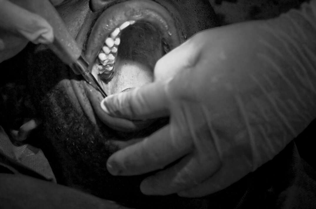 A dentist wearing a protective glove uses a medical instrument to perform a root canal procedure on a patient with their mouth wide open, dental, dentist, dental procedure, dental health, dental surgery, surgery, man, hand, glove, medical, medical instrument