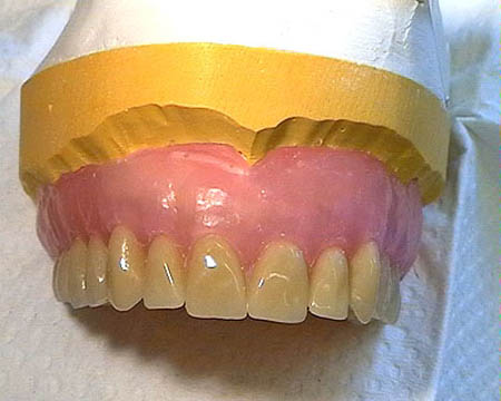 A set of dentures with pink gums and white teeth is shown during the molding process, dentures, teeth, pink gums, gums, pink, white teeth, teeth, production, mold, dental, dentist, dental insurance, insurance, dental coverage, coverage, insurance, insurance coverage, medical, medical coverage, medical insurance