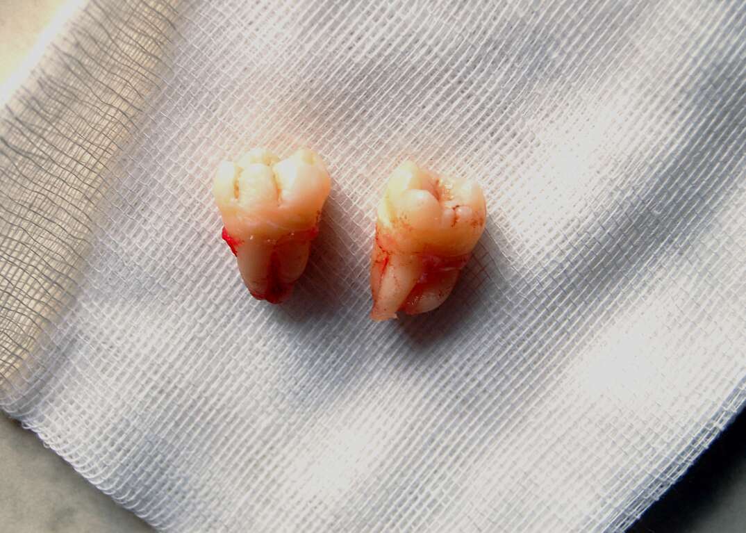 Two wisdom teeth are shown in closeup after having been surgically extracted from a human mouth, teeth, tooth, wisdom teeth, wisdom tooth, surgery, human mouth, mouth, human, oral health, dentist, dental, oral, oral health, healthcare
