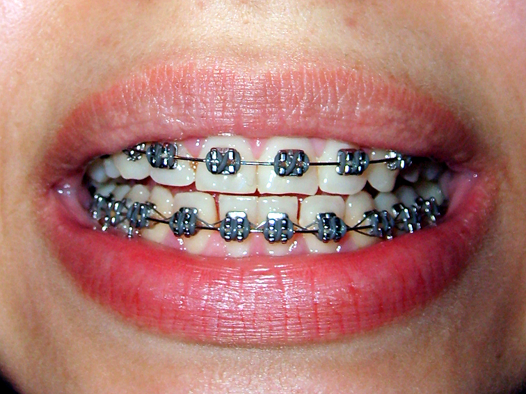 A closeup of a human face with the lips open displaying white teeth with metallic orthodontic braces attached, teeth, mouth, lips, person, human, human mouth, human teeth, braces, orthodontist, orthodontic, orthodontic braces, dental, dentist, white teeth, face, human face, closeup, extreme closeup