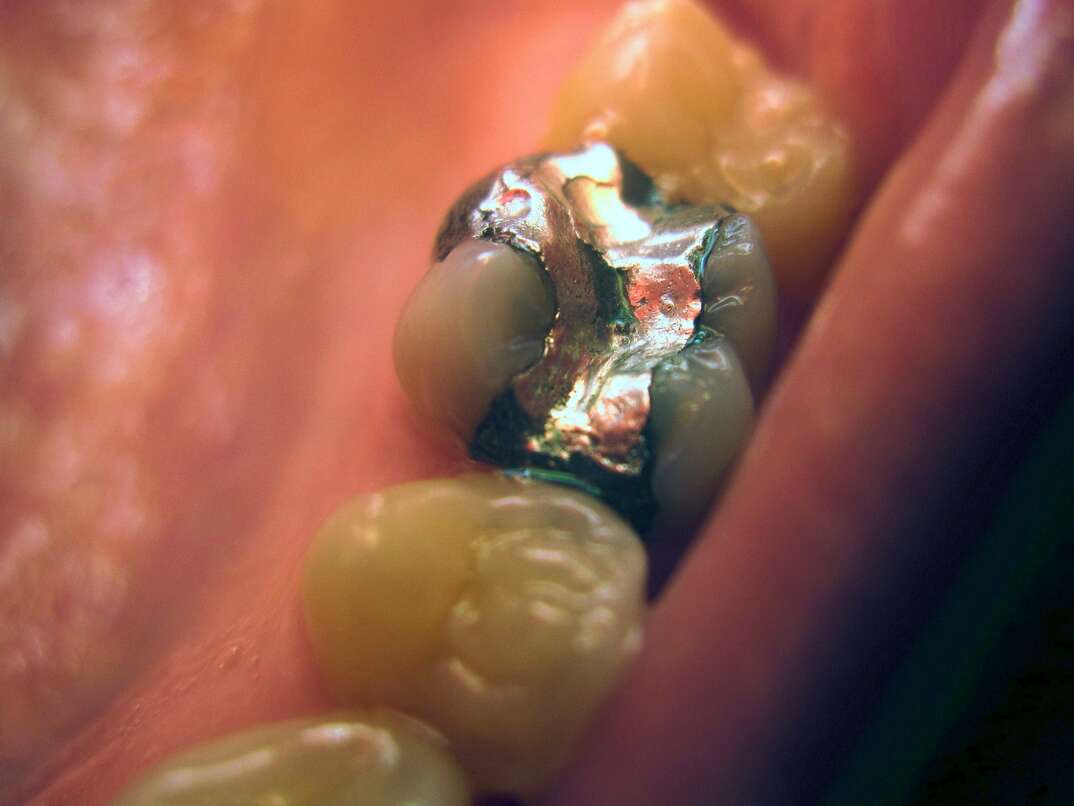A closeup up molars inside a human mouth shows one tooth with a metallic mercury dental filling, molar, molars, teeth, human teeth, human mouth, mouth, teeth, tooth, filling, fillings, mercury, metal, metallic, mercury filling, mercury fillings, metal filling, metal fillings, dentist, dental, medical, dental care, dental health, health, healthcare