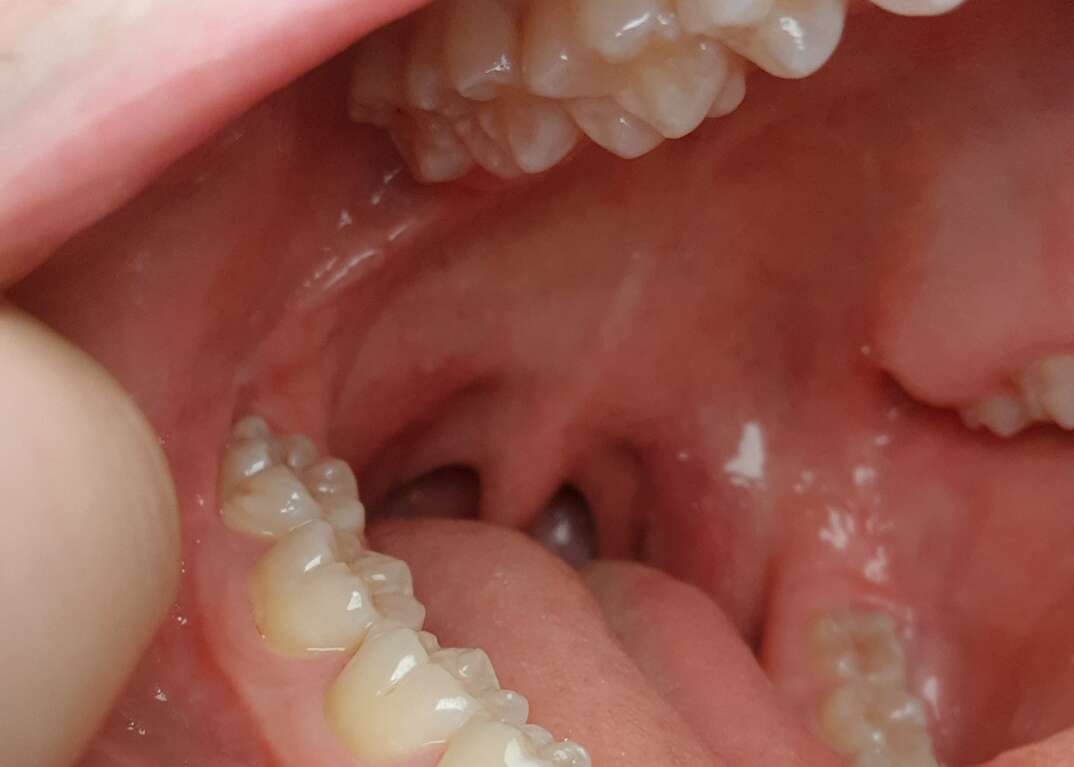 A closeup of an open human mouth shows upper and lower teeth including wisdom teeth, human mouth, wisdom teeth, mouth, human, teeth, tooth, wisdom tooth, throat, tongue, molars, wisdom, closeup