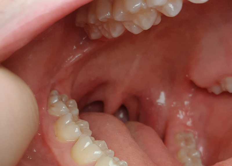 Jaw Pain 1 Month After Wisdom Teeth Removal