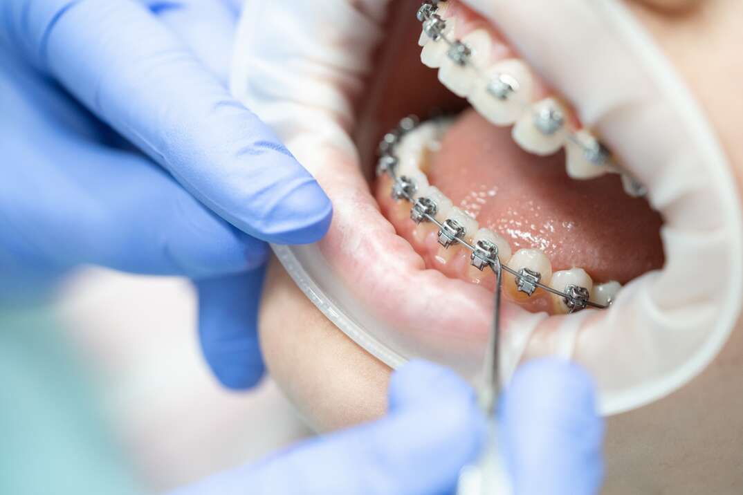 An orthodontist wearing blue latex gloves and holding medical instruments works on the open mouth of a patient with a clear plastic guard around the perimeter of the mouth and displaying teeth with metal braces affixed to them along with the tongue, braces, orthodontic braces, metal braces, teeth, mouth, tongue, lips, dental device, dental guard, orthodontist, orthodontics, dentist, dental, dental health, oral health, tooth, instruments, medical instruments, dental instruments, orthodontic instruments, blue latex gloves, gloves, latex gloves, medical